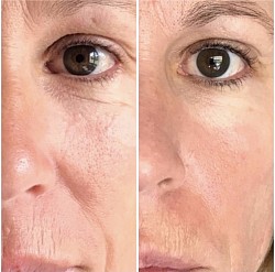 Avant 1ère / Après 3ème séance d’Aculifting Visage