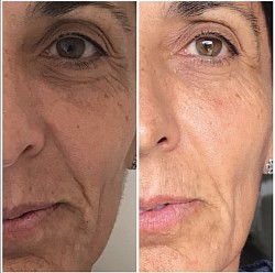 Avant 1ère / Après 3ème séance d’Aculifting Visage