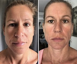 Avant 1ère / Après 2ème séance d’Aculifting Visage