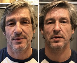 Avant / Après 1ère séance d’Aculifting Visage