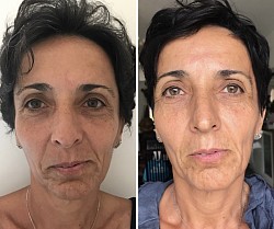 Avant 1ère / Après 3ème séance d’Aculifting Visage