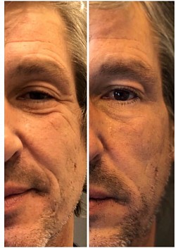 Avant 1ère / Après 2ème séance d’Aculifting Visage