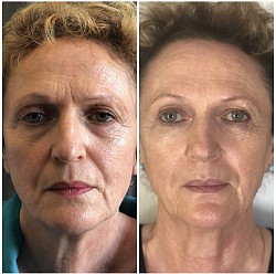 Avant / Après 1ère séance d’Aculifting Visage