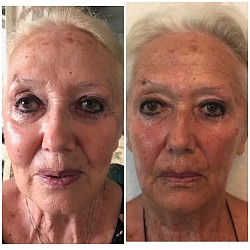 Avant 1ère / Après 5ème séance d’Aculifting Visage