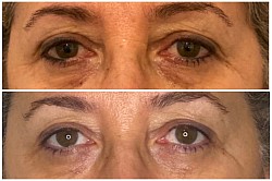 Avant 1ère / Après 3ème séance d’Aculifting Visage - Paupières, Cernes, Poches, Ridules