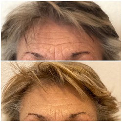 Avant 1ère / Après 4ème séance d’Aculifting Visage - Rides front