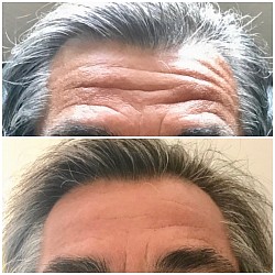Avant 1ère / Après 3ème séance d’Aculifting Visage - Rides front