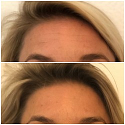 Avant 1ère / Après 3ème séance d’Aculifting Visage - Rides front