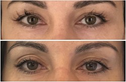 Avant 1ère / Après 3ème séance d’Aculifting Visage - Paupières