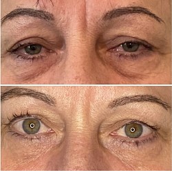 Avant 1ère / Après 5ème séance d’Aculifting Visage - Rides du lion, Paupières, Cernes, Poches, Ridules