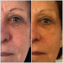 Avant 1ère / Après 3ème séance d’Aculifting Visage
