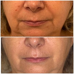 Avant 1ère / Après 3ème séance d’Aculifting Visage - Sillons nasogéniens, plis d’amertume