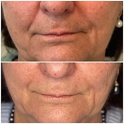 Avant 1ère / Après 3ème séance d’Aculifting Visage - Sillons nasogéniens