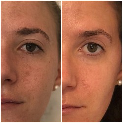 Avant 1ère / Après 3ème séance d’Aculifting Visage