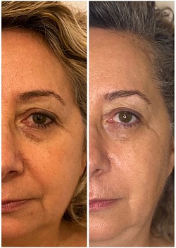 Avant 1ère / Après 3ème séance d’Aculifting Visage