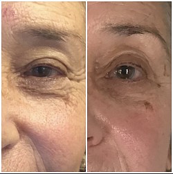 Avant / Après 1ère séance d’Aculifting Visage - Paupières, Cernes, Ridules, Rides