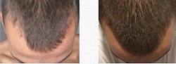 Repousse des cheveux, traitement naturel contre la chute des cheveux