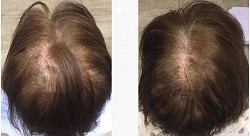 Repousse des cheveux, traitement naturel contre la perte des cheveux