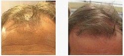 Repousse des cheveux, traitement naturel contre la perte des cheveux