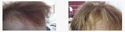 Repousse des cheveux, traitement naturel contre la perte des cheveux