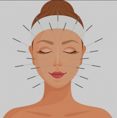 Acupuncture esthétique